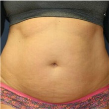 Tummy Tuck Before Photo by Steve Laverson, MD, FACS; Rancho Santa Fe, CA - Case 36579