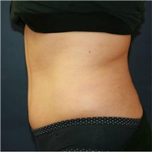 Tummy Tuck After Photo by Steve Laverson, MD, FACS; Rancho Santa Fe, CA - Case 36579