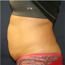 Tummy Tuck Before Photo by Steve Laverson, MD, FACS; Rancho Santa Fe, CA - Case 36579