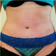 Tummy Tuck After Photo by Steve Laverson, MD, FACS; Rancho Santa Fe, CA - Case 36580