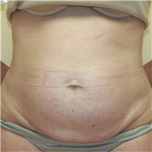 Tummy Tuck Before Photo by Steve Laverson, MD, FACS; Rancho Santa Fe, CA - Case 36580