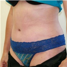 Tummy Tuck After Photo by Steve Laverson, MD, FACS; Rancho Santa Fe, CA - Case 36580