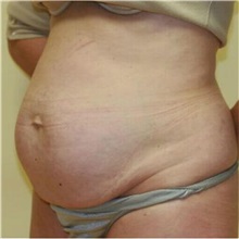 Tummy Tuck Before Photo by Steve Laverson, MD, FACS; Rancho Santa Fe, CA - Case 36580