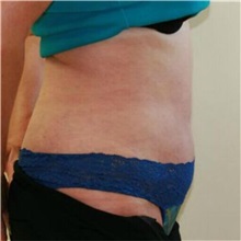 Tummy Tuck After Photo by Steve Laverson, MD, FACS; Rancho Santa Fe, CA - Case 36580