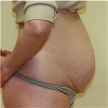 Tummy Tuck Before Photo by Steve Laverson, MD, FACS; Rancho Santa Fe, CA - Case 36580