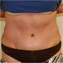 Tummy Tuck After Photo by Steve Laverson, MD; San Diego, CA - Case 36581