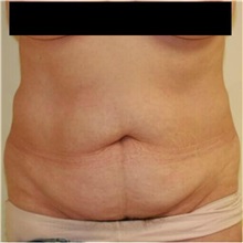 Tummy Tuck Before Photo by Steve Laverson, MD; San Diego, CA - Case 36581