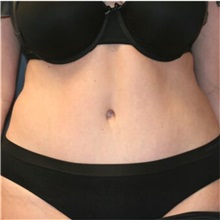 Tummy Tuck After Photo by Steve Laverson, MD; San Diego, CA - Case 36594