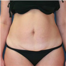 Tummy Tuck Before Photo by Steve Laverson, MD, FACS; Rancho Santa Fe, CA - Case 36594