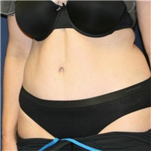 Tummy Tuck After Photo by Steve Laverson, MD, FACS; Rancho Santa Fe, CA - Case 36594