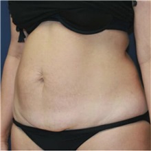 Tummy Tuck Before Photo by Steve Laverson, MD, FACS; Rancho Santa Fe, CA - Case 36594