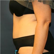 Tummy Tuck After Photo by Steve Laverson, MD, FACS; Rancho Santa Fe, CA - Case 36594