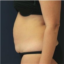 Tummy Tuck Before Photo by Steve Laverson, MD, FACS; Rancho Santa Fe, CA - Case 36594