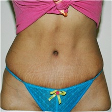 Tummy Tuck After Photo by Steve Laverson, MD; San Diego, CA - Case 36595