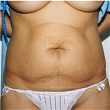 Tummy Tuck Before Photo by Steve Laverson, MD; San Diego, CA - Case 36595