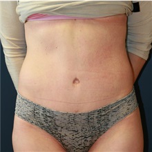 Tummy Tuck After Photo by Steve Laverson, MD, FACS; Rancho Santa Fe, CA - Case 36598