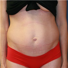 Tummy Tuck Before Photo by Steve Laverson, MD, FACS; Rancho Santa Fe, CA - Case 36598