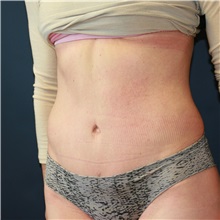 Tummy Tuck After Photo by Steve Laverson, MD, FACS; Rancho Santa Fe, CA - Case 36598