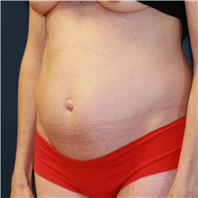 Tummy Tuck Before Photo by Steve Laverson, MD, FACS; Rancho Santa Fe, CA - Case 36598