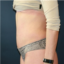 Tummy Tuck After Photo by Steve Laverson, MD, FACS; Rancho Santa Fe, CA - Case 36598