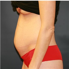 Tummy Tuck Before Photo by Steve Laverson, MD, FACS; Rancho Santa Fe, CA - Case 36598