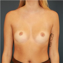 Breast Augmentation Before Photo by Steve Laverson, MD, FACS; Rancho Santa Fe, CA - Case 36639