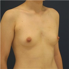 Breast Augmentation Before Photo by Steve Laverson, MD, FACS; San Diego, CA - Case 36640