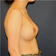 Breast Augmentation After Photo by Steve Laverson, MD, FACS; Rancho Santa Fe, CA - Case 36640