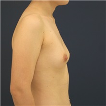 Breast Augmentation Before Photo by Steve Laverson, MD, FACS; San Diego, CA - Case 36640