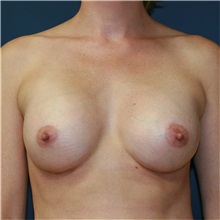 Breast Augmentation After Photo by Steve Laverson, MD, FACS; Rancho Santa Fe, CA - Case 36679
