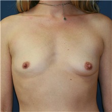 Breast Augmentation Before Photo by Steve Laverson, MD, FACS; San Diego, CA - Case 36679