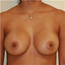 Breast Augmentation After Photo by Steve Laverson, MD, FACS; San Diego, CA - Case 36681