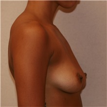 Breast Augmentation Before Photo by Steve Laverson, MD, FACS; Rancho Santa Fe, CA - Case 36681