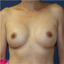 Breast Augmentation After Photo by Steve Laverson, MD, FACS; Rancho Santa Fe, CA - Case 36682