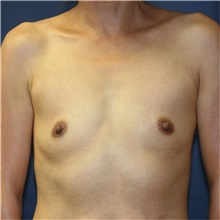 Breast Augmentation Before Photo by Steve Laverson, MD, FACS; San Diego, CA - Case 36682