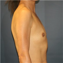 Breast Augmentation Before Photo by Steve Laverson, MD, FACS; Rancho Santa Fe, CA - Case 36682