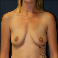 Breast Augmentation Before Photo by Steve Laverson, MD, FACS; Rancho Santa Fe, CA - Case 36684