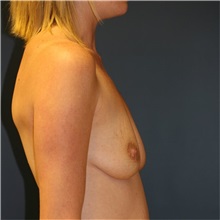 Breast Augmentation Before Photo by Steve Laverson, MD, FACS; Rancho Santa Fe, CA - Case 36684