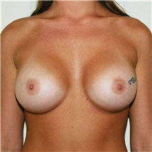 Breast Augmentation After Photo by Steve Laverson, MD; San Diego, CA - Case 36686