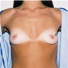 Breast Augmentation Before Photo by Steve Laverson, MD; San Diego, CA - Case 36686