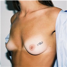 Breast Augmentation Before Photo by Steve Laverson, MD, FACS; San Diego, CA - Case 36686
