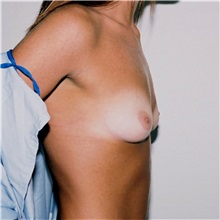 Breast Augmentation Before Photo by Steve Laverson, MD, FACS; Rancho Santa Fe, CA - Case 36686