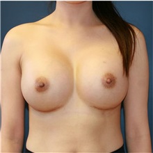 Breast Augmentation After Photo by Steve Laverson, MD, FACS; Rancho Santa Fe, CA - Case 36687