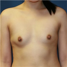 Breast Augmentation Before Photo by Steve Laverson, MD, FACS; Rancho Santa Fe, CA - Case 36687