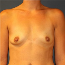 Breast Augmentation Before Photo by Steve Laverson, MD, FACS; Rancho Santa Fe, CA - Case 36706