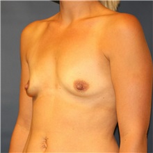 Breast Augmentation Before Photo by Steve Laverson, MD, FACS; Rancho Santa Fe, CA - Case 36706