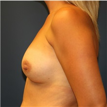 Breast Augmentation After Photo by Steve Laverson, MD, FACS; Rancho Santa Fe, CA - Case 36706