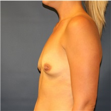 Breast Augmentation Before Photo by Steve Laverson, MD, FACS; Rancho Santa Fe, CA - Case 36706