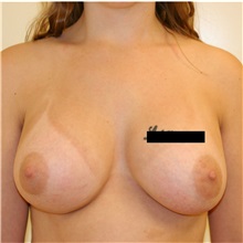 Breast Augmentation After Photo by Steve Laverson, MD, FACS; Rancho Santa Fe, CA - Case 36707