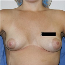 Breast Augmentation Before Photo by Steve Laverson, MD, FACS; Rancho Santa Fe, CA - Case 36707